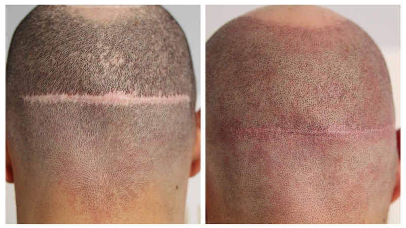 hair-transplant-scar-coverup-fue